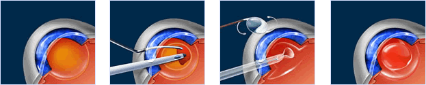 Intraocular lens (IOL) used during cataract surgery