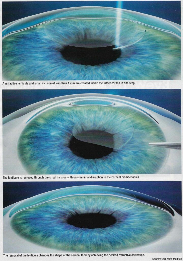 smile eye surgery diagram