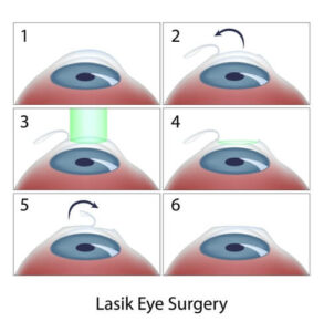 step by step diagram of LASIK surgery